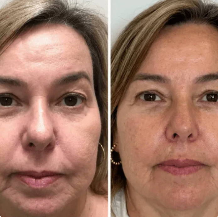 Collagen Fit - Efeito lifting imediato sem agulhas nem dor.