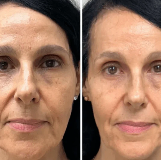 Collagen Fit - Efeito lifting imediato sem agulhas nem dor.